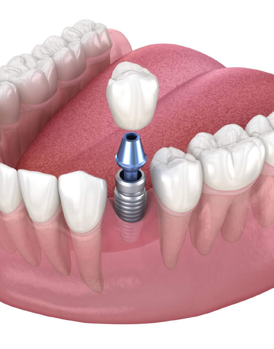 implant dentar brasov